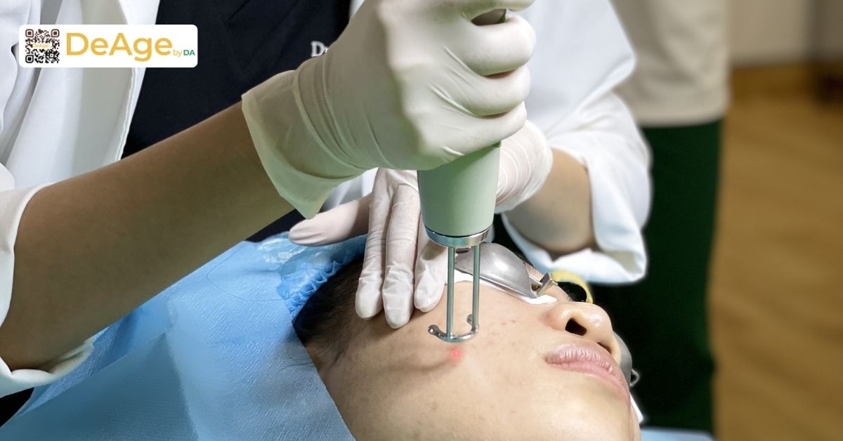 Giải mã vai trò của cysteamine: giải pháp mới cho nám và tăng sắc tố mạn tính 12 laser