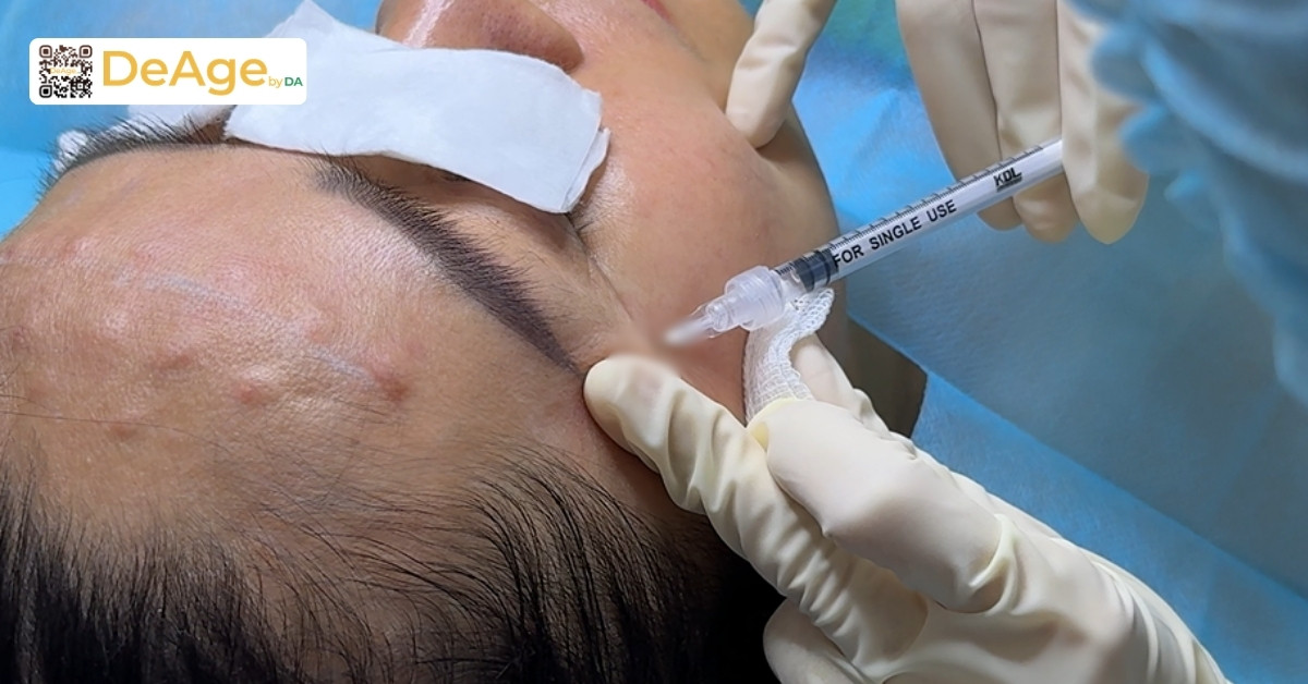 Nên tiêm filler hay botox, phương pháp nào tốt hơn? 2 BS tiêm botox