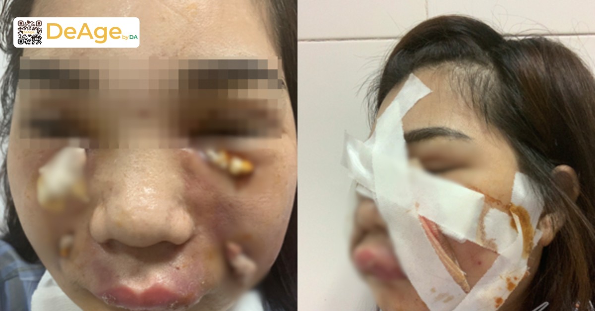 Nên tiêm filler hay mỡ tự thân để cân chỉnh gương mặt? 6 Biến chứng tiêm mỡ tự thân
