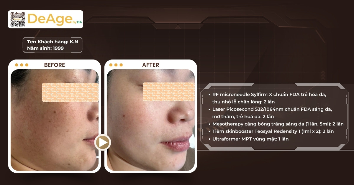 Sóng RF là gì và ứng dụng của sóng RF trong thẩm mỹ 7 CLS Trẻ hóa da có sylfirm X