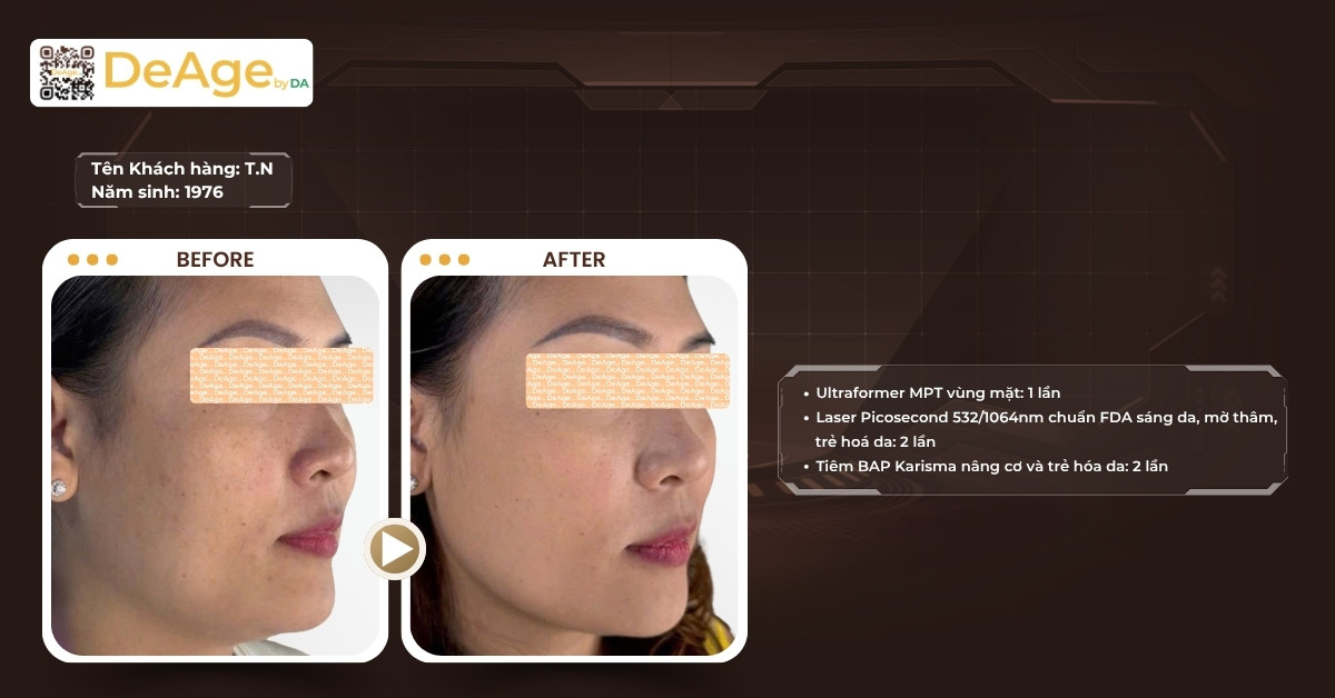 Tại sao phải bổ sung collagen và những yếu tố khiến collagen suy giảm nhanh 10 CLS có tiêm BAP karisma