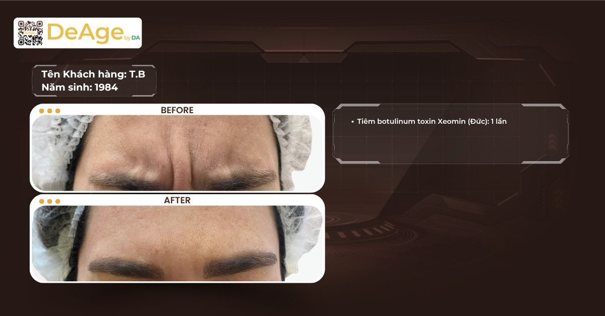 Nên tiêm filler hay botox, phương pháp nào tốt hơn? 5 CLS tiêm botox xóa nhăn
