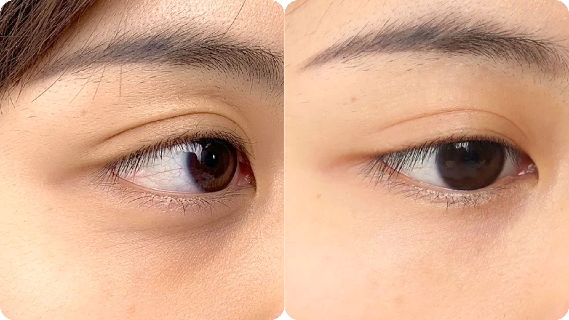 Cải thiện chất lượng da và sắc tố vùng mắt