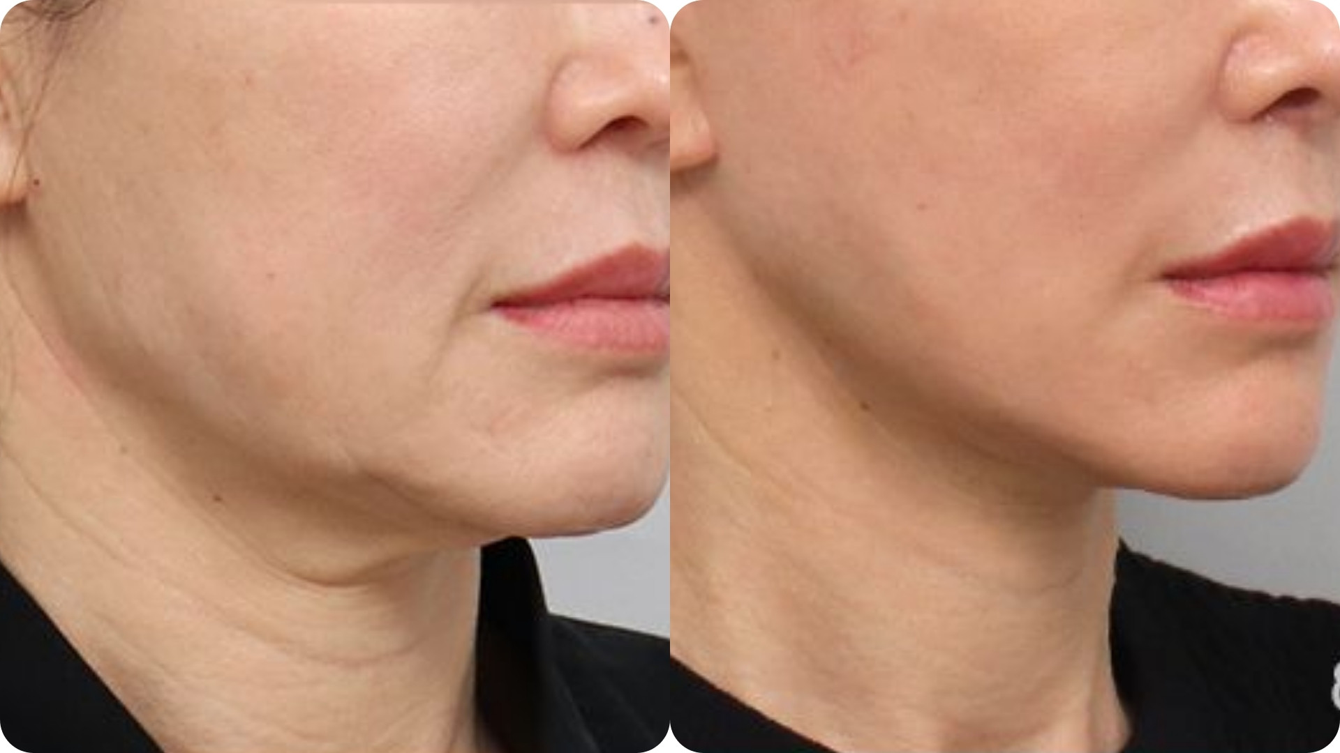 Ultherapy Prime 10