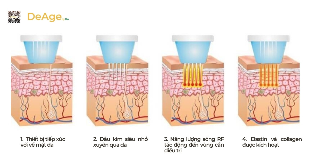 RF vi điểm là gì và hiệu quả nổi bật trong trẻ hóa da 3 Cơ chế hoạt động của công nghệ RF vi điểm