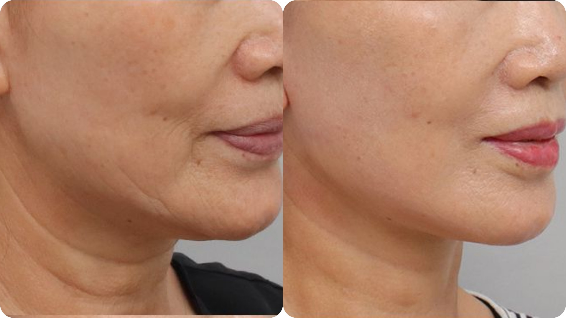 Ultherapy Prime 6