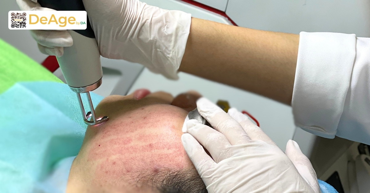 Tái tạo da là gì và những phương pháp tái tạo da phổ biến hiện nay 6 Laser Nd_YAG