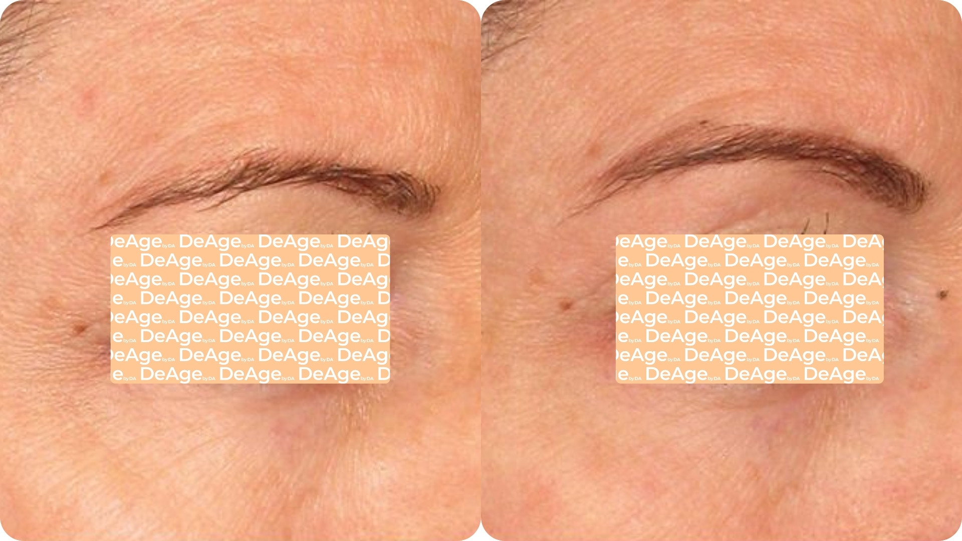 Ultherapy Prime 4