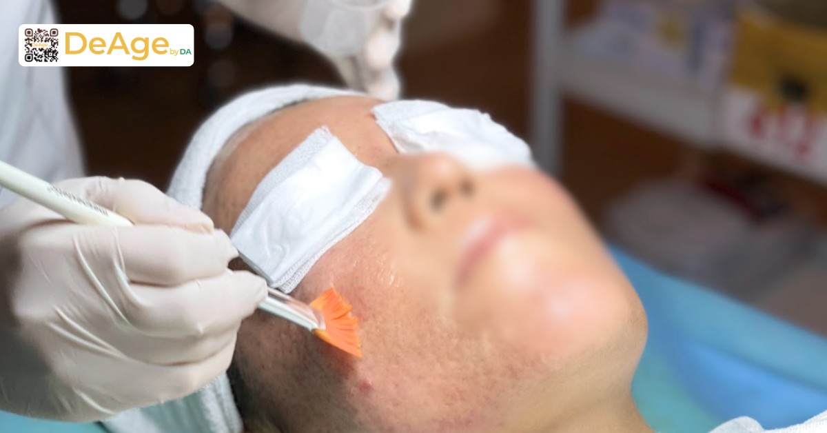 Tái tạo da là gì và những phương pháp tái tạo da phổ biến hiện nay 8 Peel da
