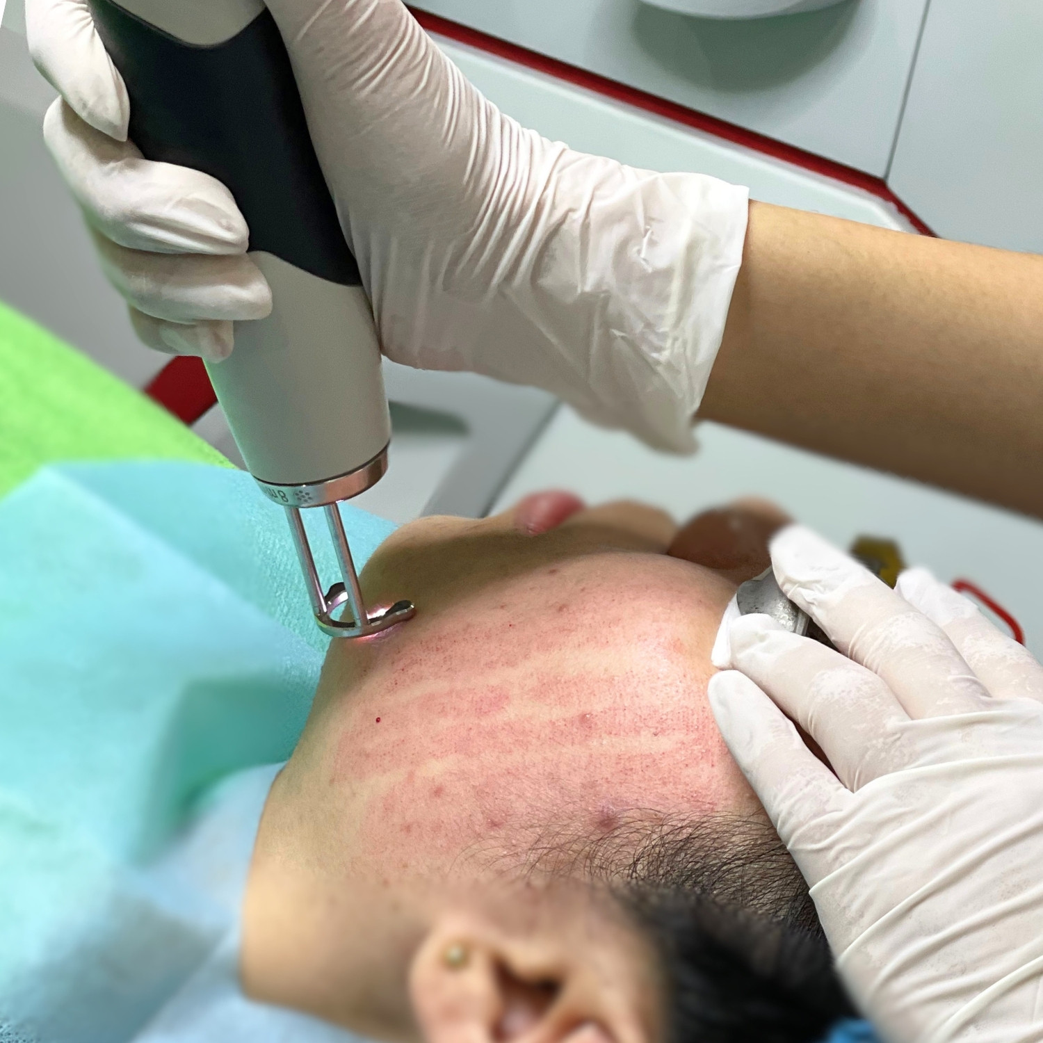 Phục hồi da sau các liệu trình không xâm lấn