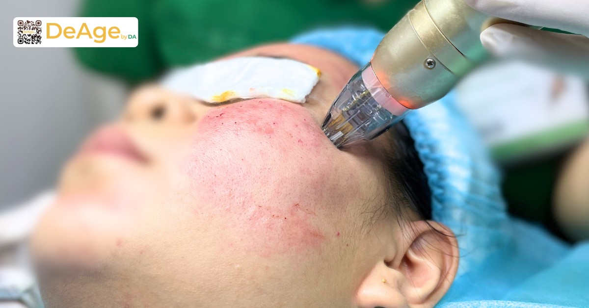 Tái tạo da là gì và những phương pháp tái tạo da phổ biến hiện nay 10 RF sylfirm X