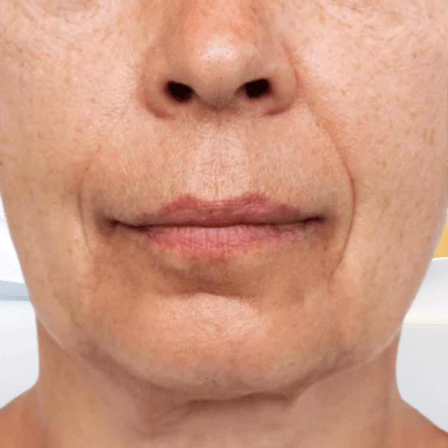Ultherapy Prime 16