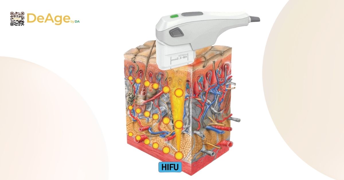 HIFU và InMode Lift trong nâng cơ và giảm mỡ mặt, nên chọn phương pháp nào? 2 Sóng siêu âm hội tụ tạo ra nhiệt độ cao ở lớp hạ bì và lớp mỡ dưới da, giúp phá hủy các tế bào mỡ