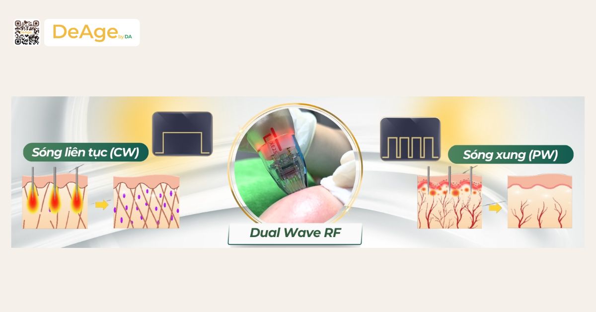 RF vi điểm là gì và hiệu quả nổi bật trong trẻ hóa da 9 Sylfirm X công nghệ RF sóng kép hiện đại từ Hàn Quốc