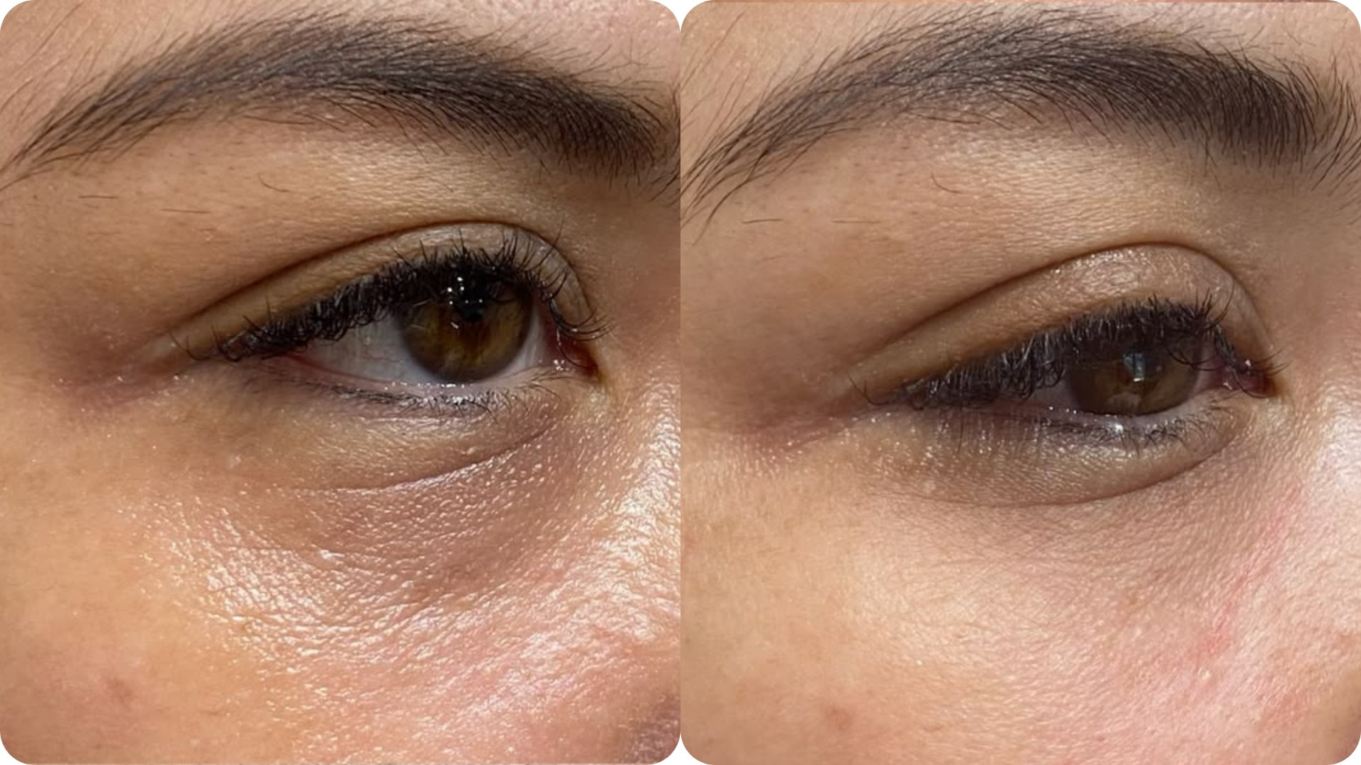 Tái cấu trúc nền da và kích thích tăng sinh collagen