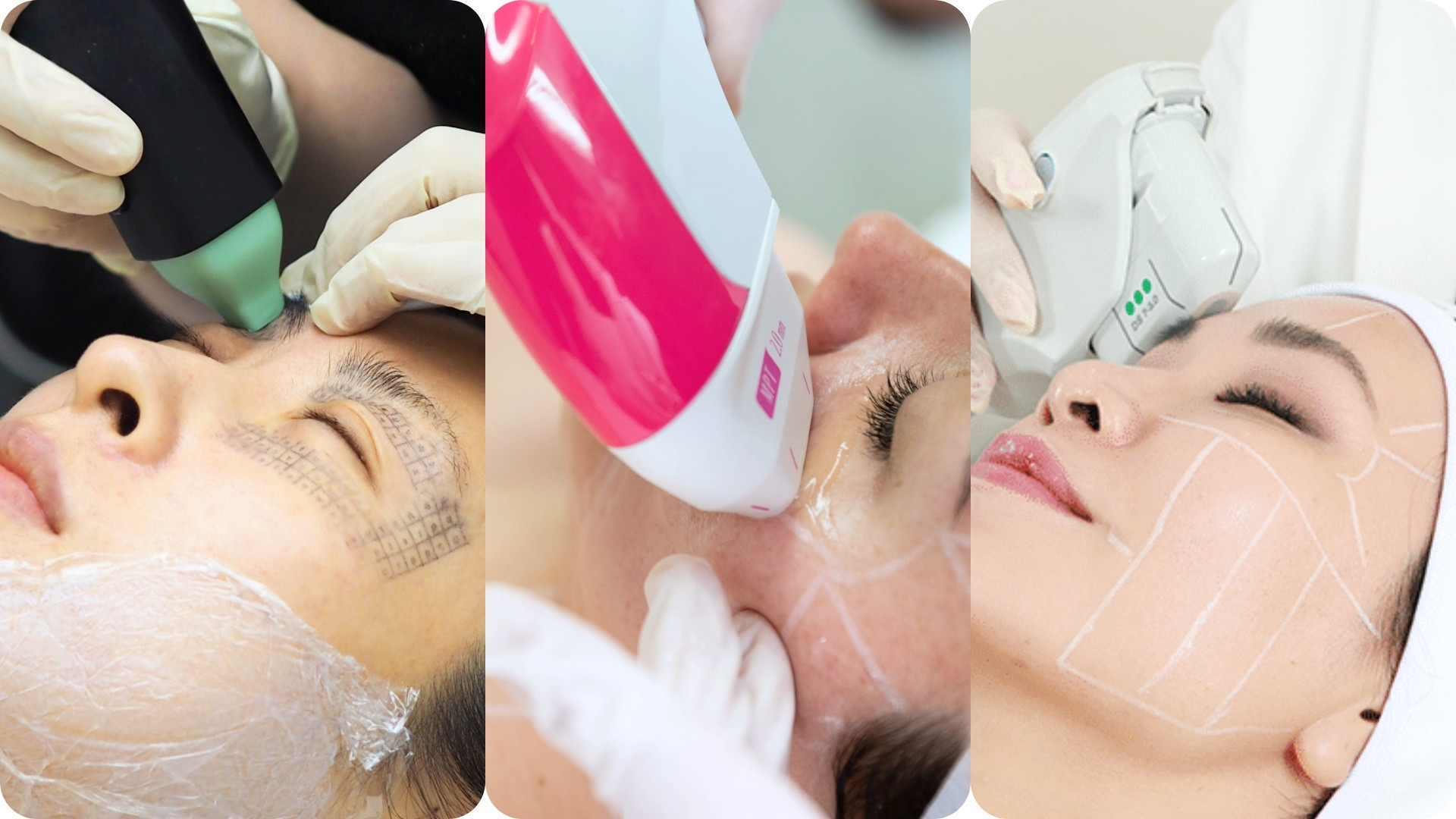 Tăng nâng đỡ các cấu trúc quanh mắt