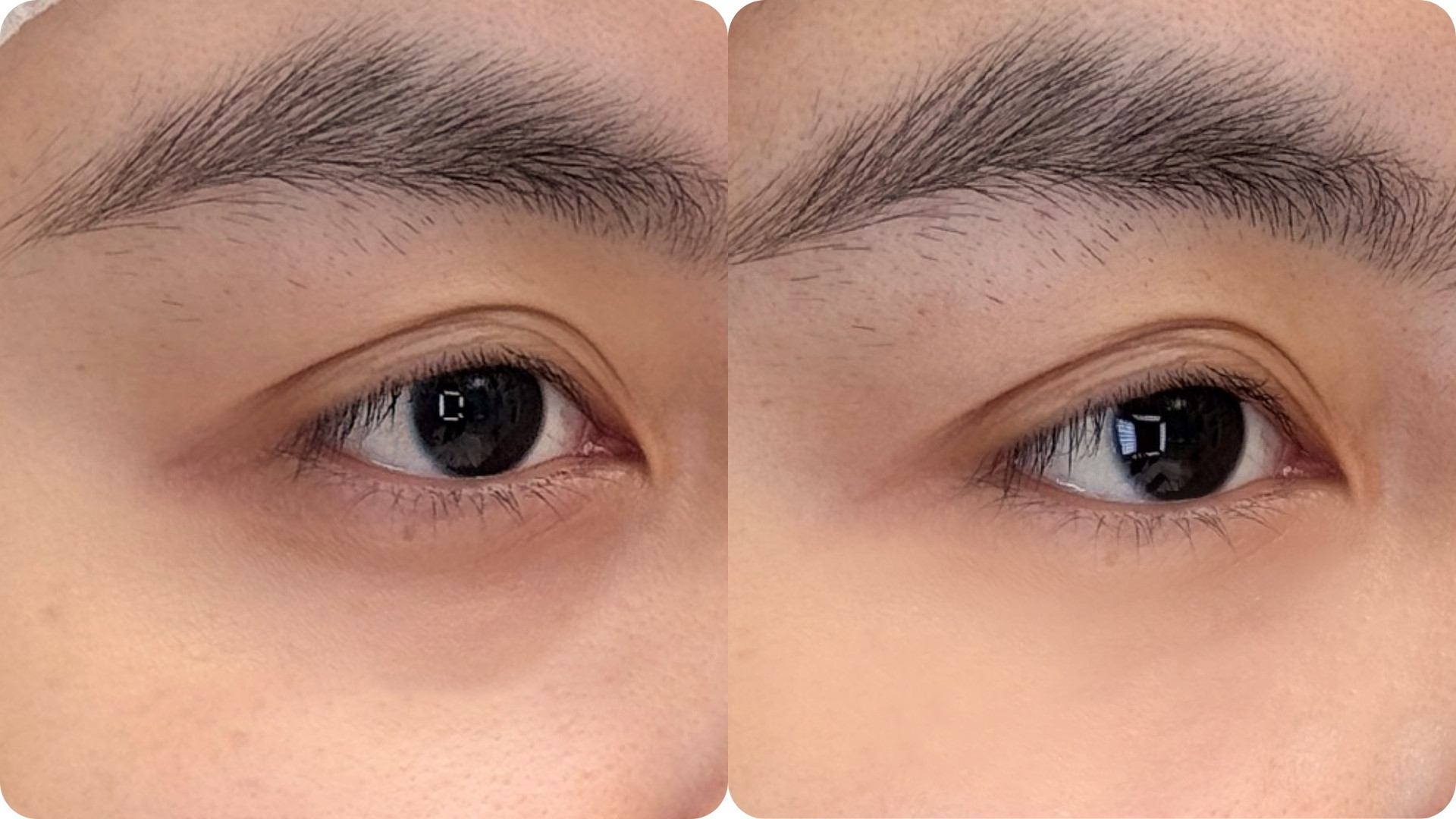 Tăng nâng đỡ cấu trúc quanh mắt