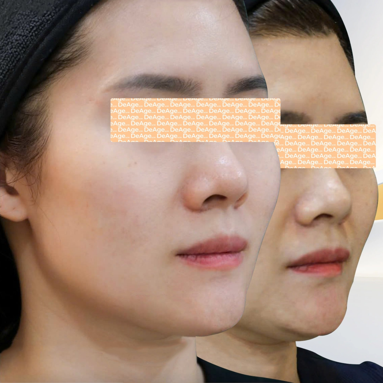 Ultherapy Prime 20
