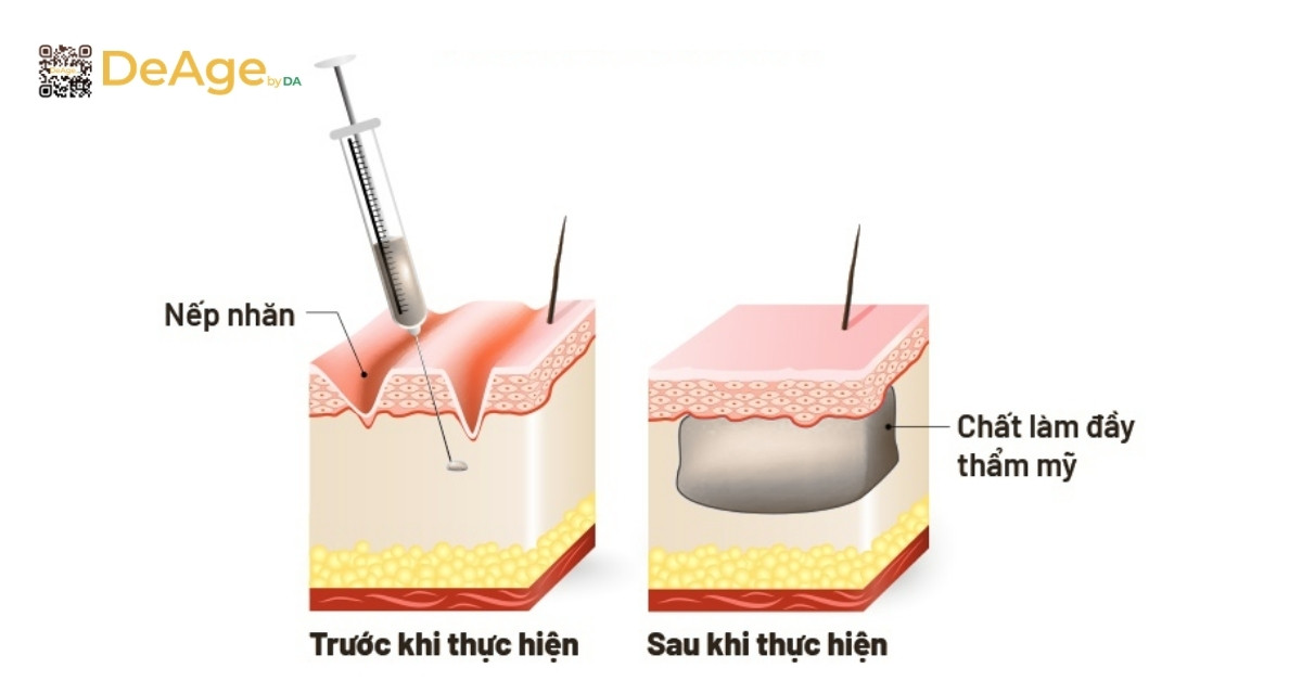 Nên tiêm filler hay botox, phương pháp nào tốt hơn? 1 Tiêm filler là gì