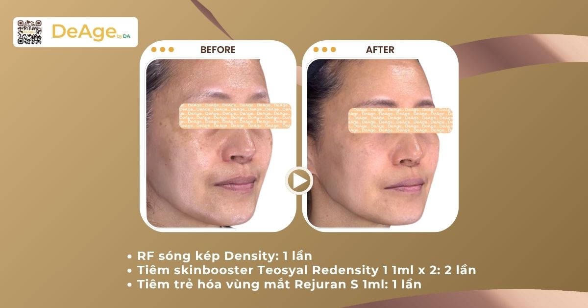 Những cách bổ sung collagen cho da giúp cải thiện độ săn chắc và đàn hồi 9 ca lâm sàng bổ sung collagen