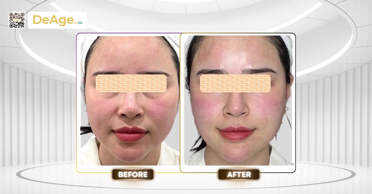 Công nghệ CFU là gì? Nguyên lý hoạt động, hiệu quả và đối tượng phù hợp 8 ca lâm sàng điều trị bằng công nghệ CFU Èlife