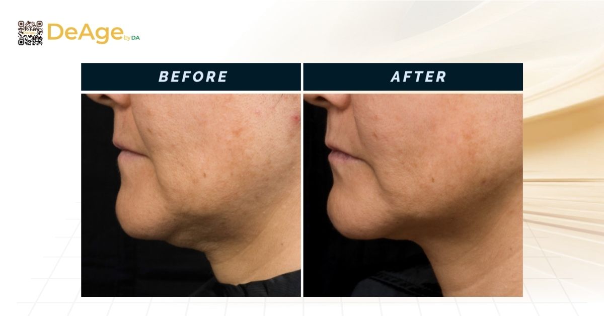 Công nghệ Thermage là gì và hiệu quả trong nâng cơ trẻ hóa da 3 ca lâm sàng điều trị bằng công nghệ Thermage FLX