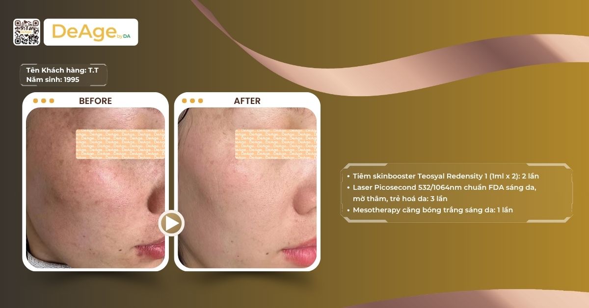 Laser pico là gì và các ứng dụng trong trẻ hóa da 7 ca lâm sàng laser pico