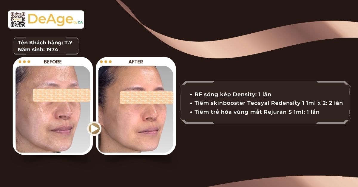 Thermage FLX và Density: công nghệ nào hiệu quả hơn trong nâng cơ, trẻ hóa da? 5 ca lâm sàng rf density