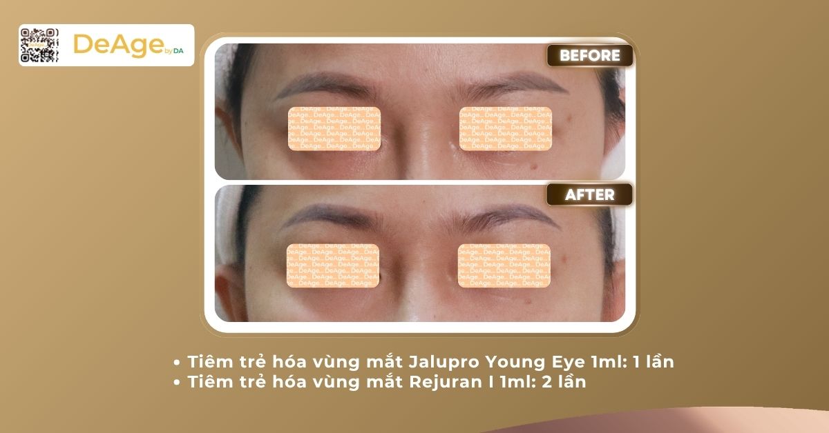 3 loại nếp nhăn dưới mắt và cách khắc phục hiệu quả 6 ca lâm sàng tiêm mắt