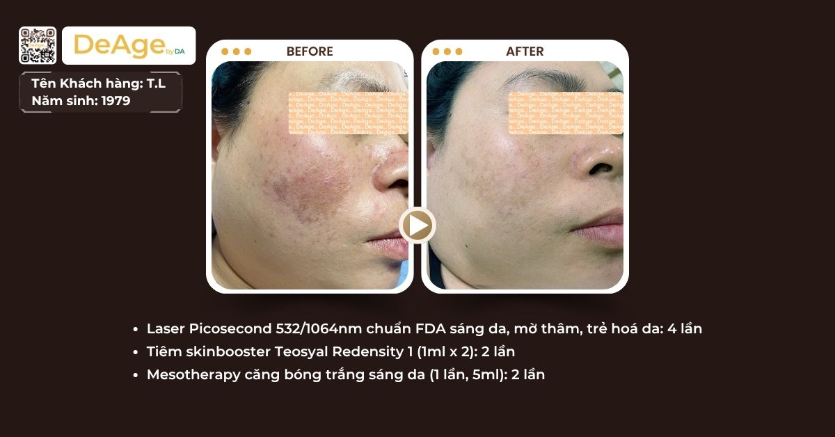 Mesotherapy là gì? Hiệu quả và đối tượng phù hợp với phương pháp này 4 ca lâm sàng tiêm meso