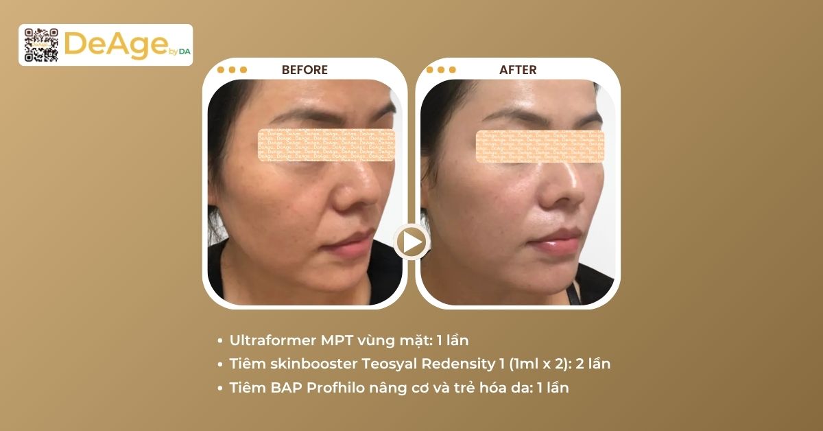 Công nghệ Ultherapy và vai trò trong nâng cơ trẻ hóa da hiện nay 4 ca lâm sàng tiêm skinbooster
