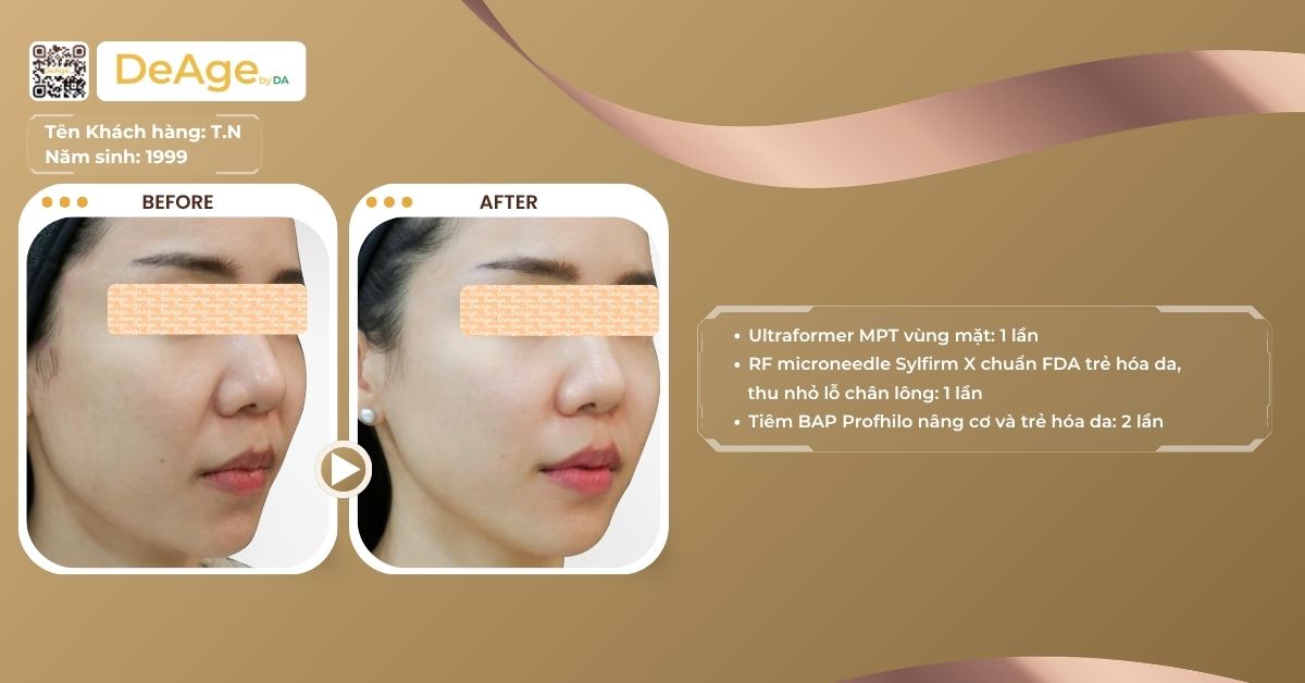 Công nghệ HIFU - Nâng cơ trẻ hóa và giảm mỡ mặt không cần phẫu thuật 11 ca lâm sàng trẻ hóa da bằn hifu