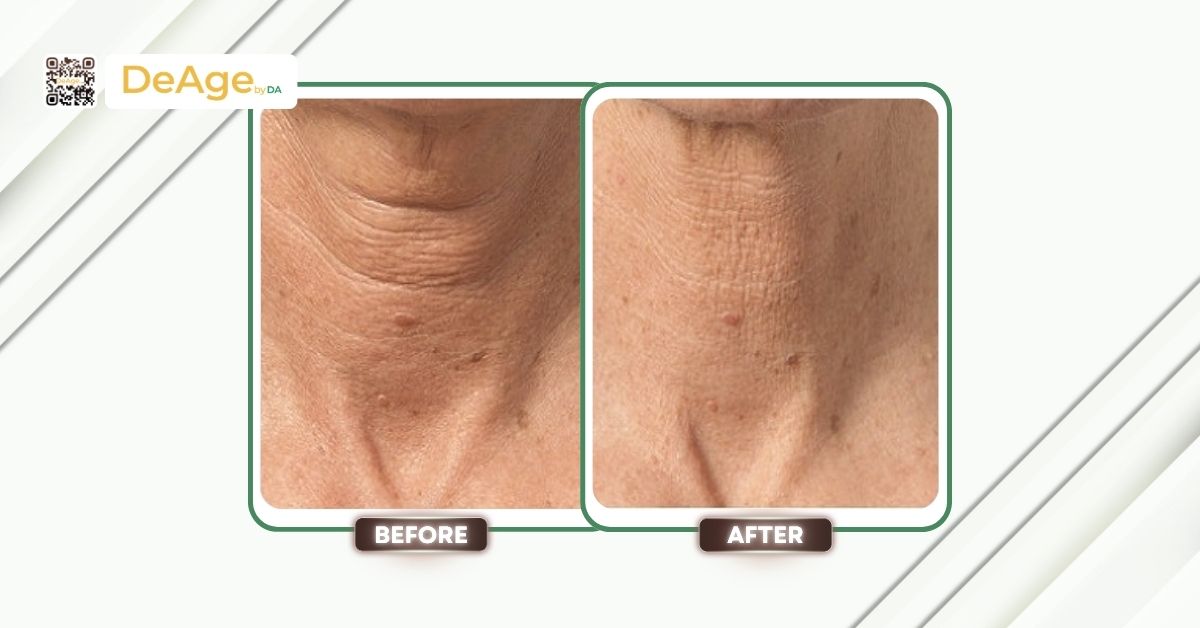 Các phương pháp trẻ hóa vùng cổ ít xâm lấn và địa chỉ thực hiện an toàn 15 ca lâm sàng trẻ hóa vùng cổ tại DeAge by DA