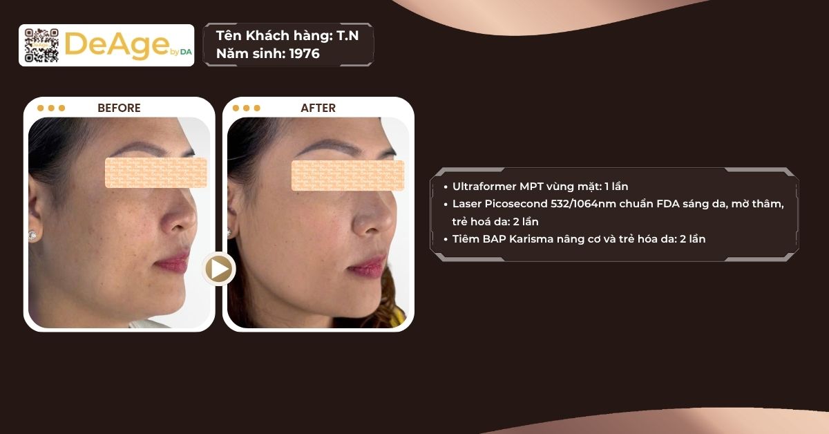 Nếp nhăn động là gì và làm cách nào để cải thiện hiệu quả? 18 ca lâm sàng