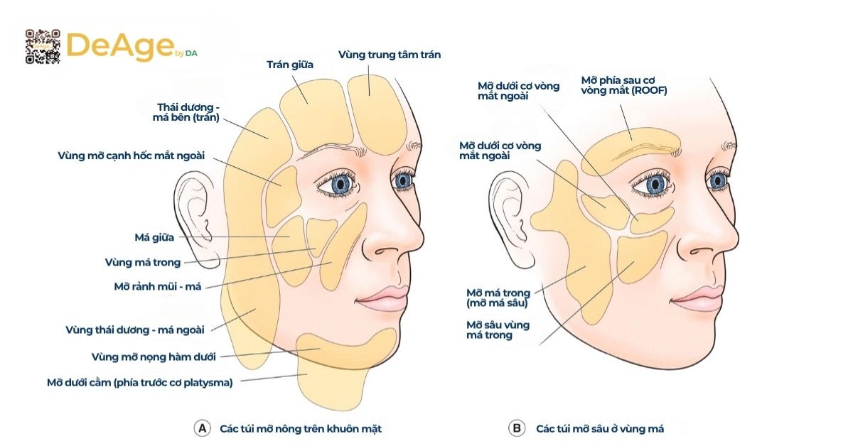 Nguyên nhân hình thành rãnh mũi má sâu và 8 phương pháp cải thiện hiệu quả 2 cấu trúc các túi mỡ phân bố tại nhiều vùng trên mặt