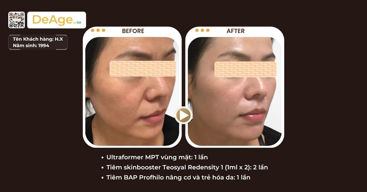 Mesotherapy là gì? Hiệu quả và đối tượng phù hợp với phương pháp này 3 cls meso