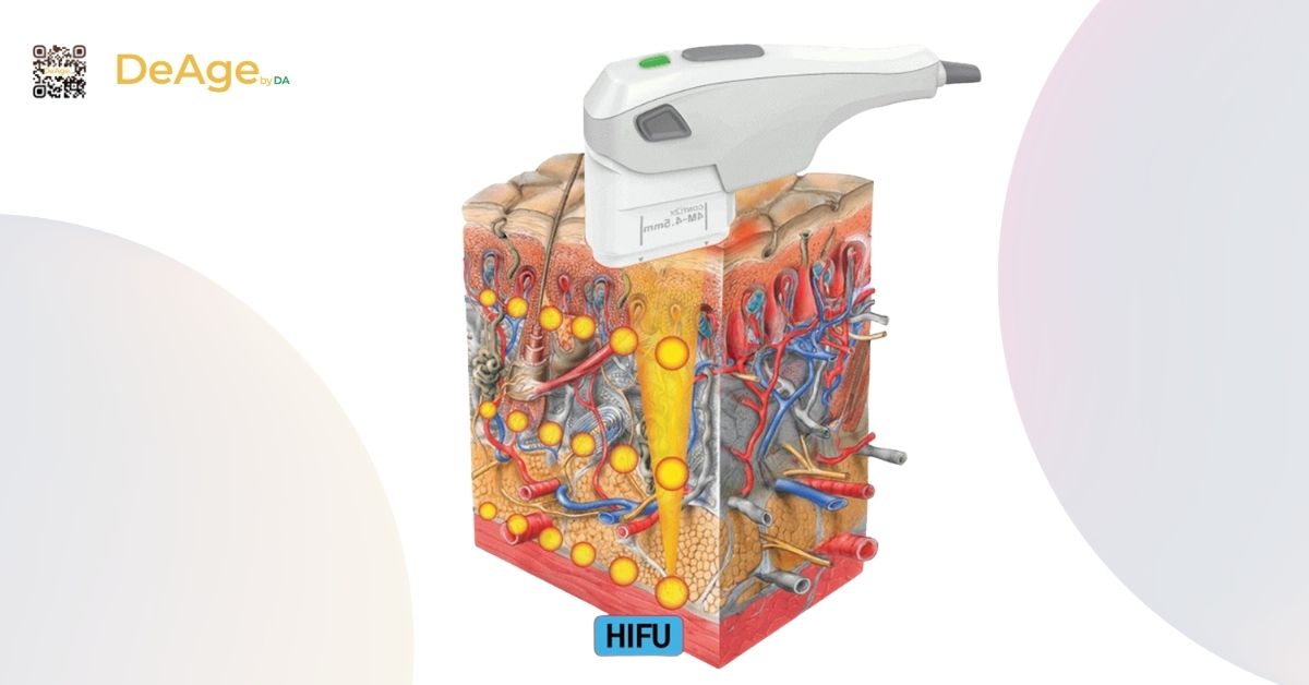 Công nghệ HIFU - Nâng cơ trẻ hóa và giảm mỡ mặt không cần phẫu thuật 3 cơ chế hifu