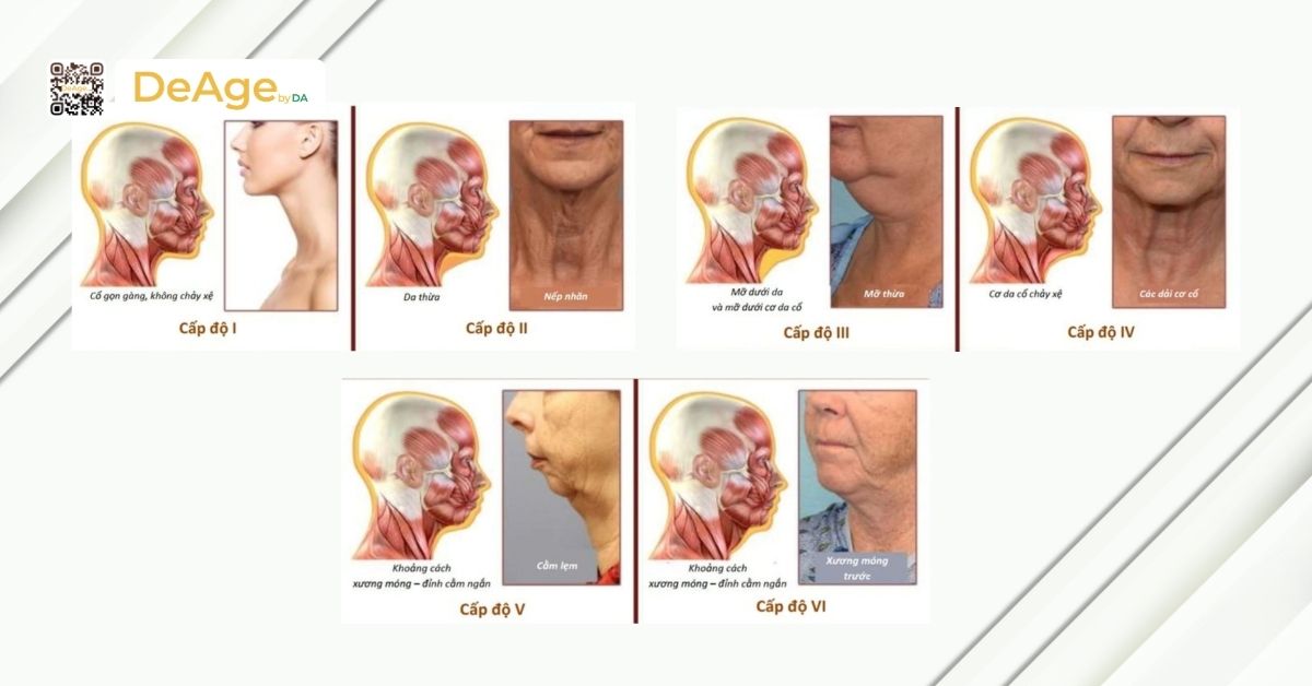 Các phương pháp trẻ hóa vùng cổ ít xâm lấn và địa chỉ thực hiện an toàn 3 hệ thống Dedo dùng để phân loại lão hóa da cổ
