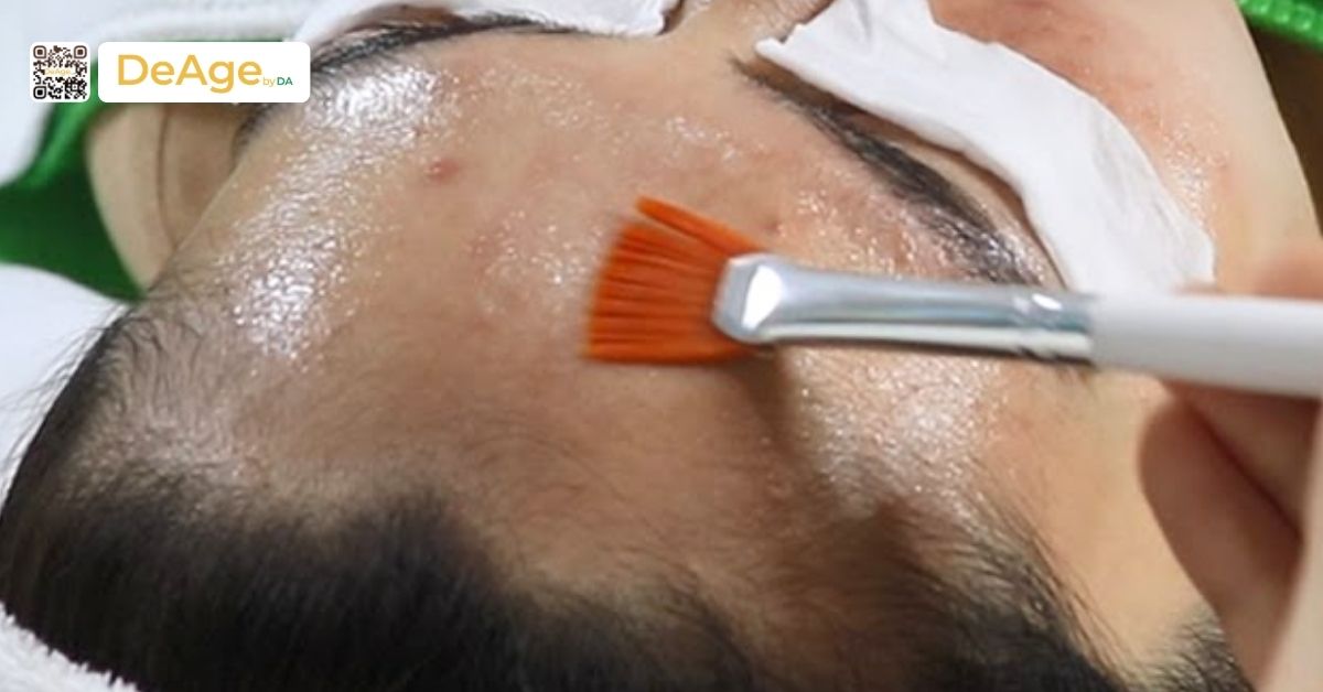 Nếp nhăn động là gì và làm cách nào để cải thiện hiệu quả? 15 hình peel da