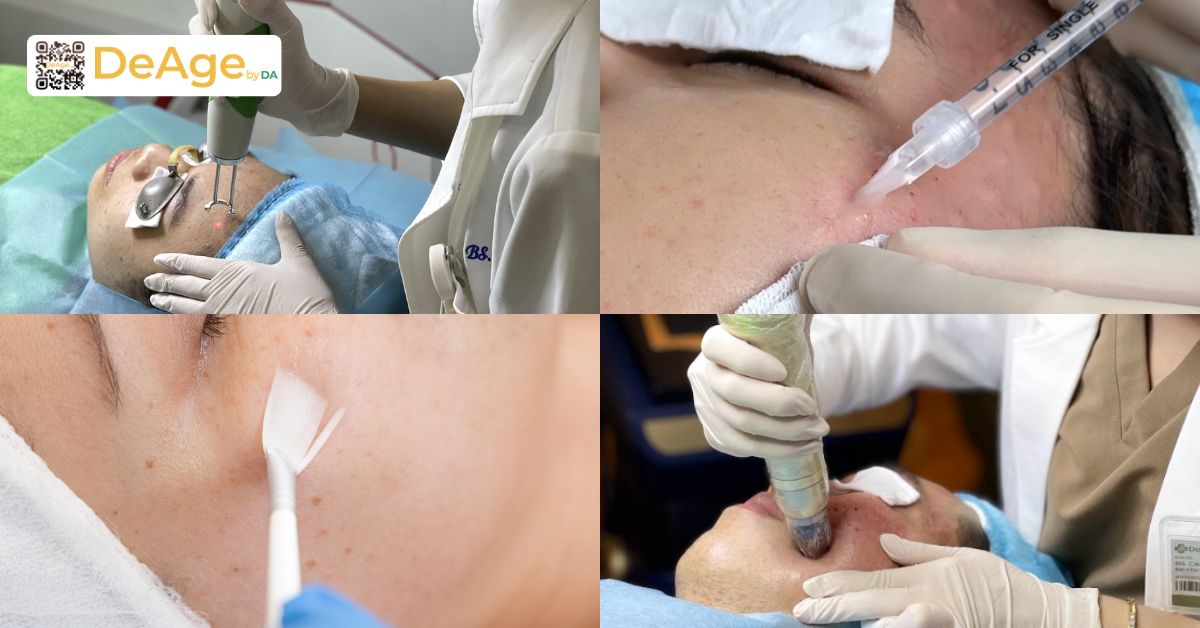 Tiêm thuốc tránh thai có bị nám da không? 9 kết hợp đa phương thức trong điều trị giúp tăng hiệu quả cải thiện thâm nám rõ rệt