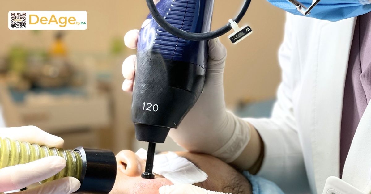 Nếp nhăn động là gì và làm cách nào để cải thiện hiệu quả? 11 laser fractional