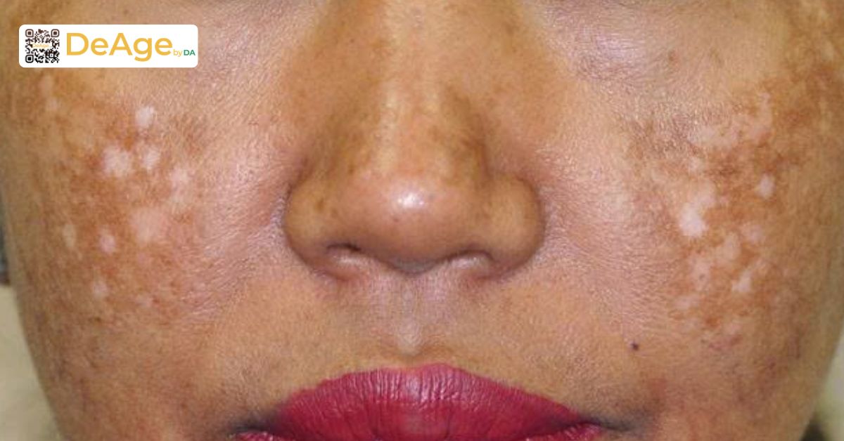 Giải mã vai trò của cysteamine: giải pháp mới cho nám và tăng sắc tố mạn tính 6 mất sắc tố