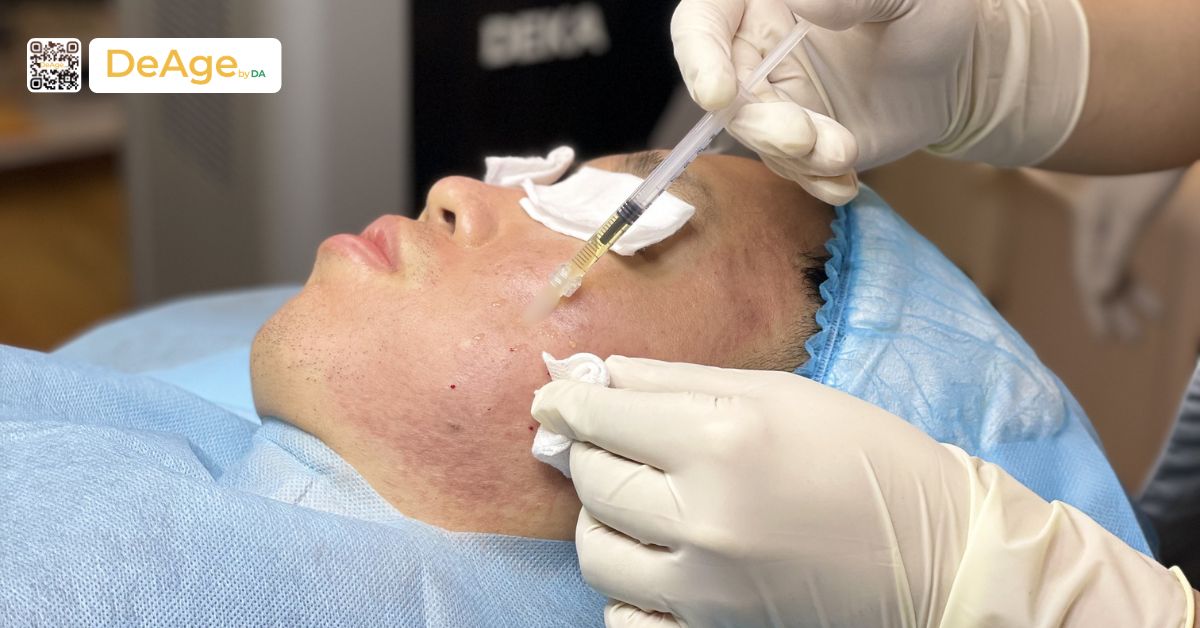 Mesotherapy là gì? Hiệu quả và đối tượng phù hợp với phương pháp này 9 meso sẹo rỗ