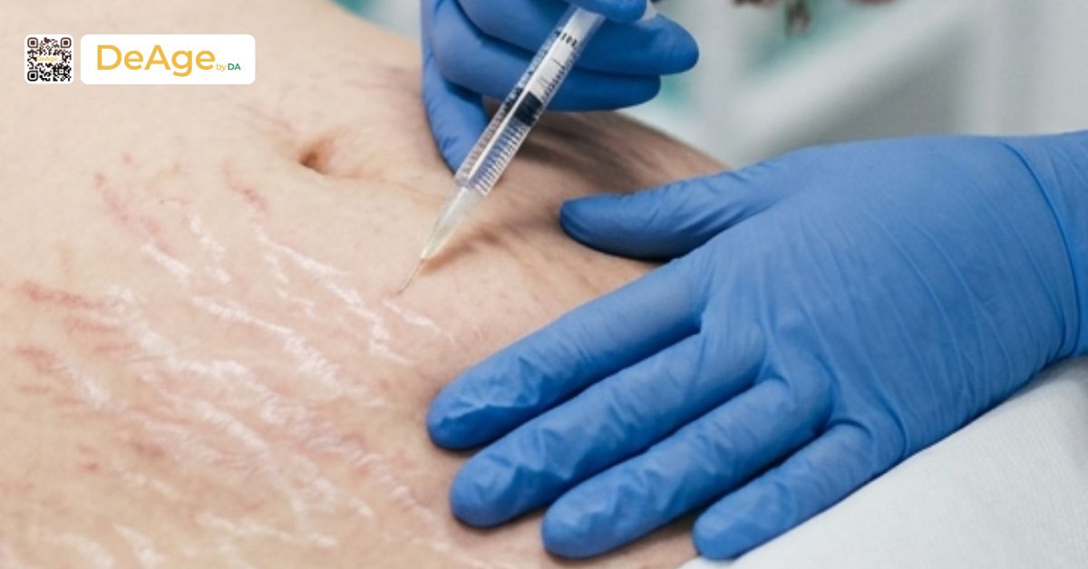 Mesotherapy là gì? Hiệu quả và đối tượng phù hợp với phương pháp này 7 meso trị rạn