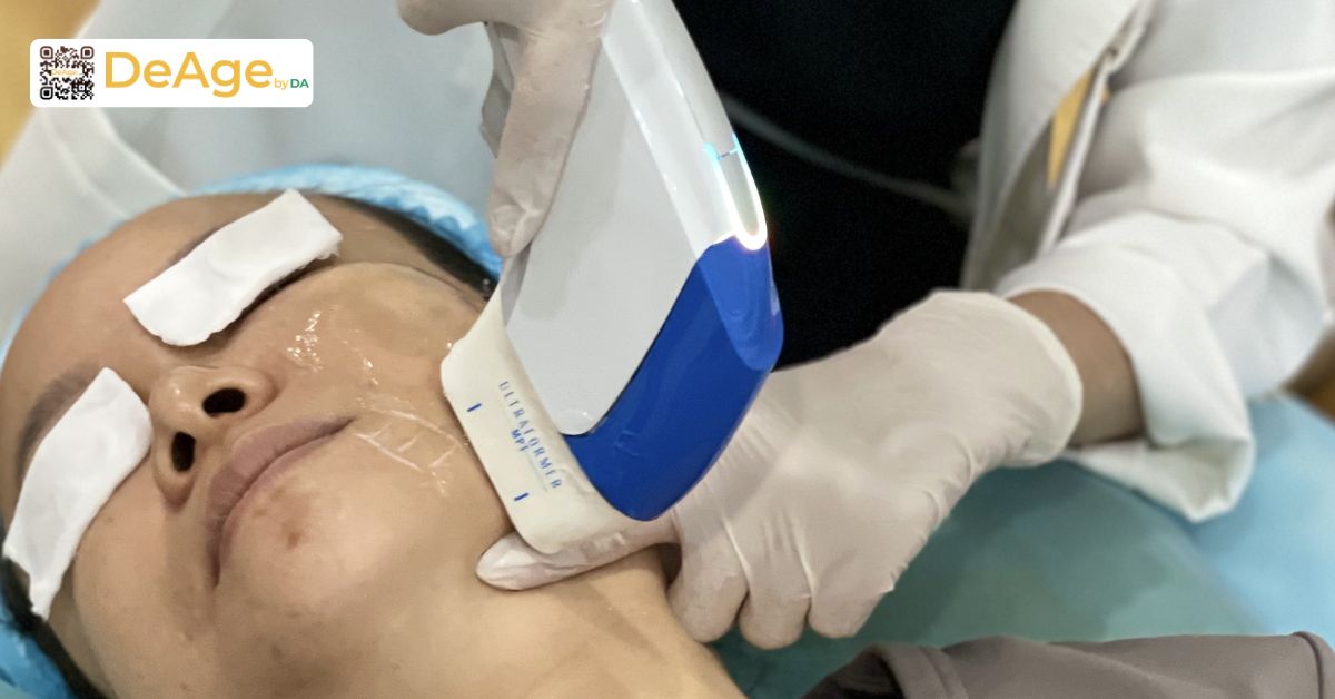 Nếp nhăn động là gì và làm cách nào để cải thiện hiệu quả? 14 mpt