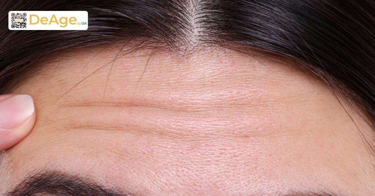 Top các phương pháp xóa nếp nhăn trán hiệu quả nhất hiện nay 1 nếp nhăn vùng trán