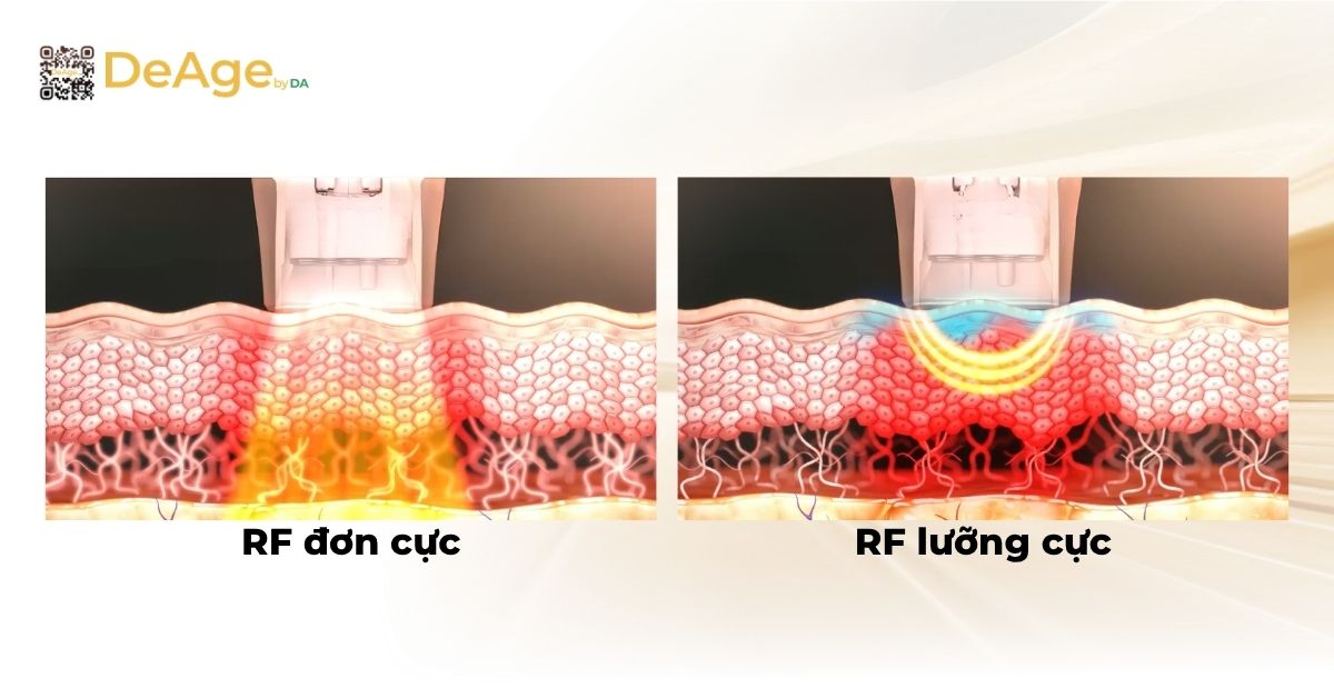 Thermage FLX và Density: công nghệ nào hiệu quả hơn trong nâng cơ, trẻ hóa da? 3 rf đơn cục và rf lưỡng cực