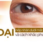 3 loại nếp nhăn dưới mắt và cách khắc phục hiệu quả