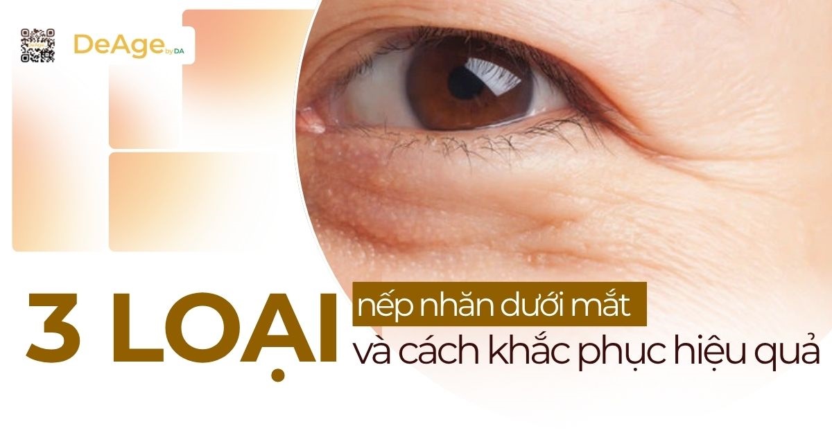 thumb 3 loại nếp nhăn dưới mắt và cách khắc phục hiệu quả