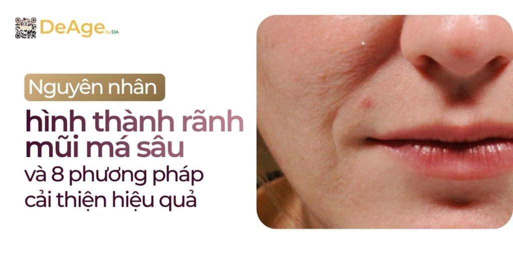 thumb Nguyên nhân hình thành rãnh mũi má sâu và 8 phương pháp cải thiện hiệu quả